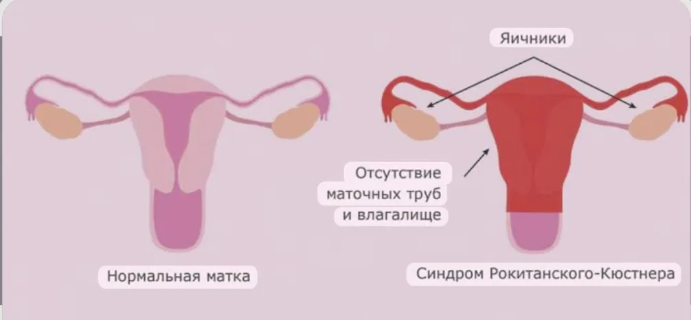 Синдром Рокитанского — Кюстнера — Майера. #2