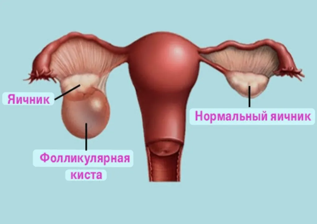 Фолликулярная киста #2