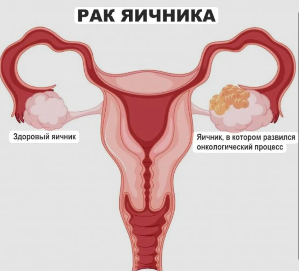 Рак яичников #2