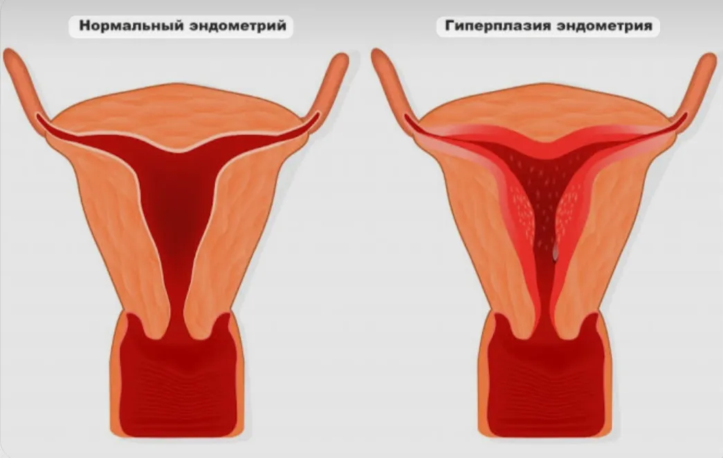  А что, если слизистая матки растёт слишком сильно? #1