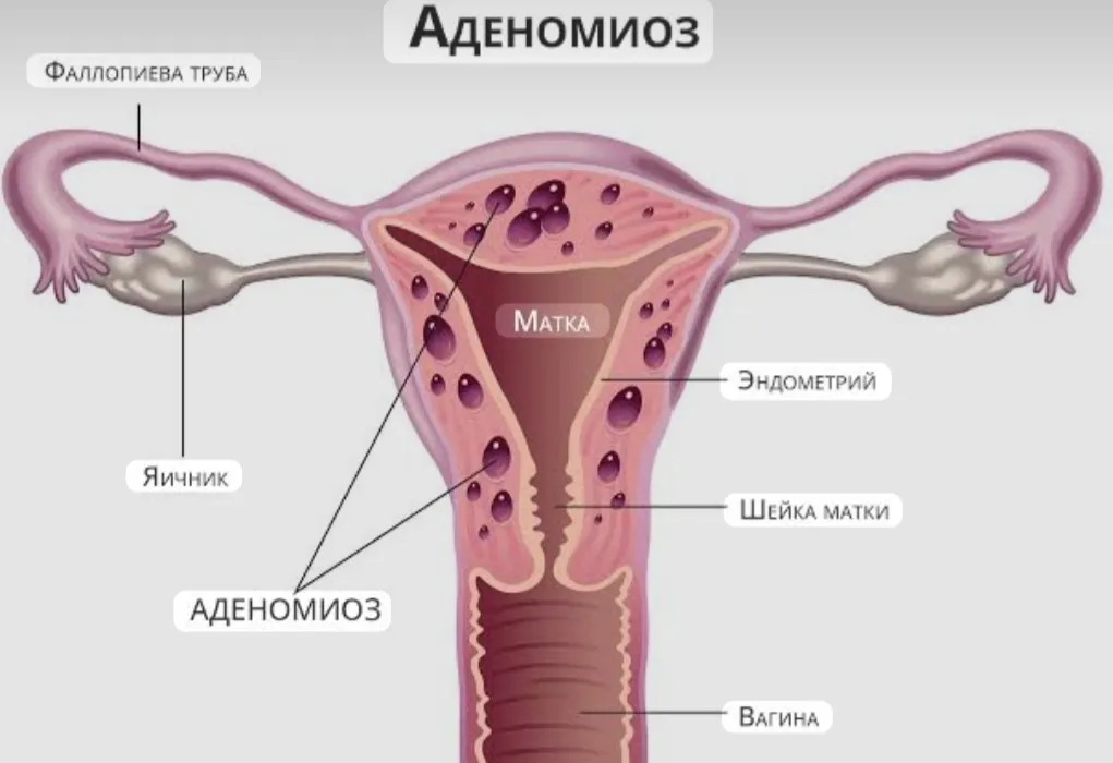Аденомиоз #1