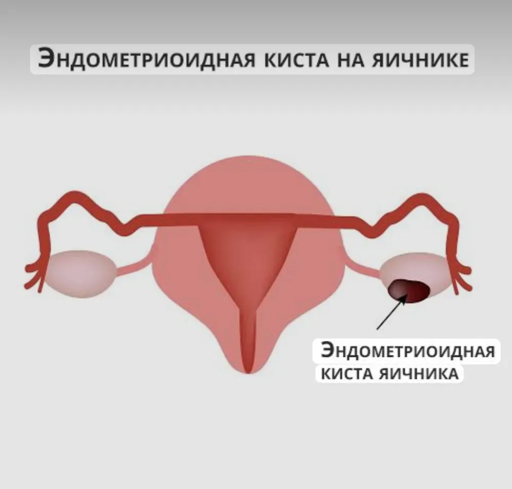 Эндометриоидная киста яичника #2