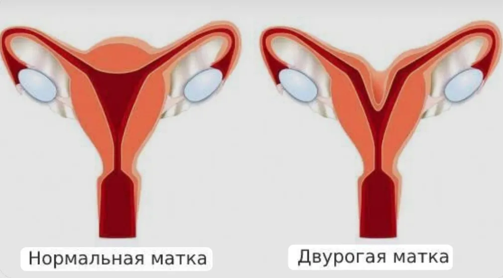 Двурогая матка #2