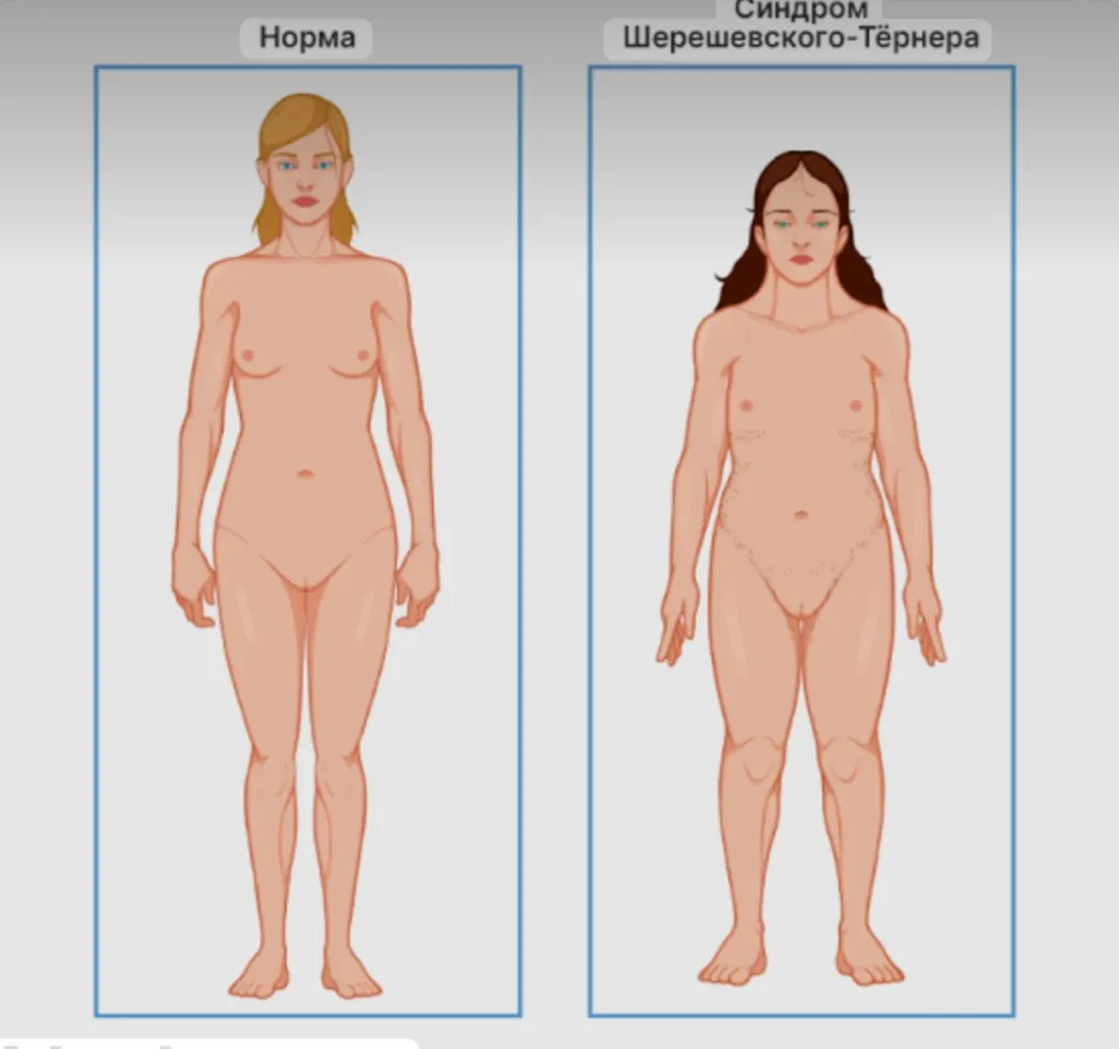  Синдром Шерешевского–Тёрнера #2