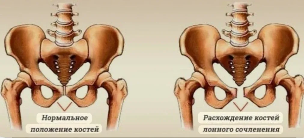 Сегодня у одной из наших беременных диагностировали симфизит. 🤰🏻 #1