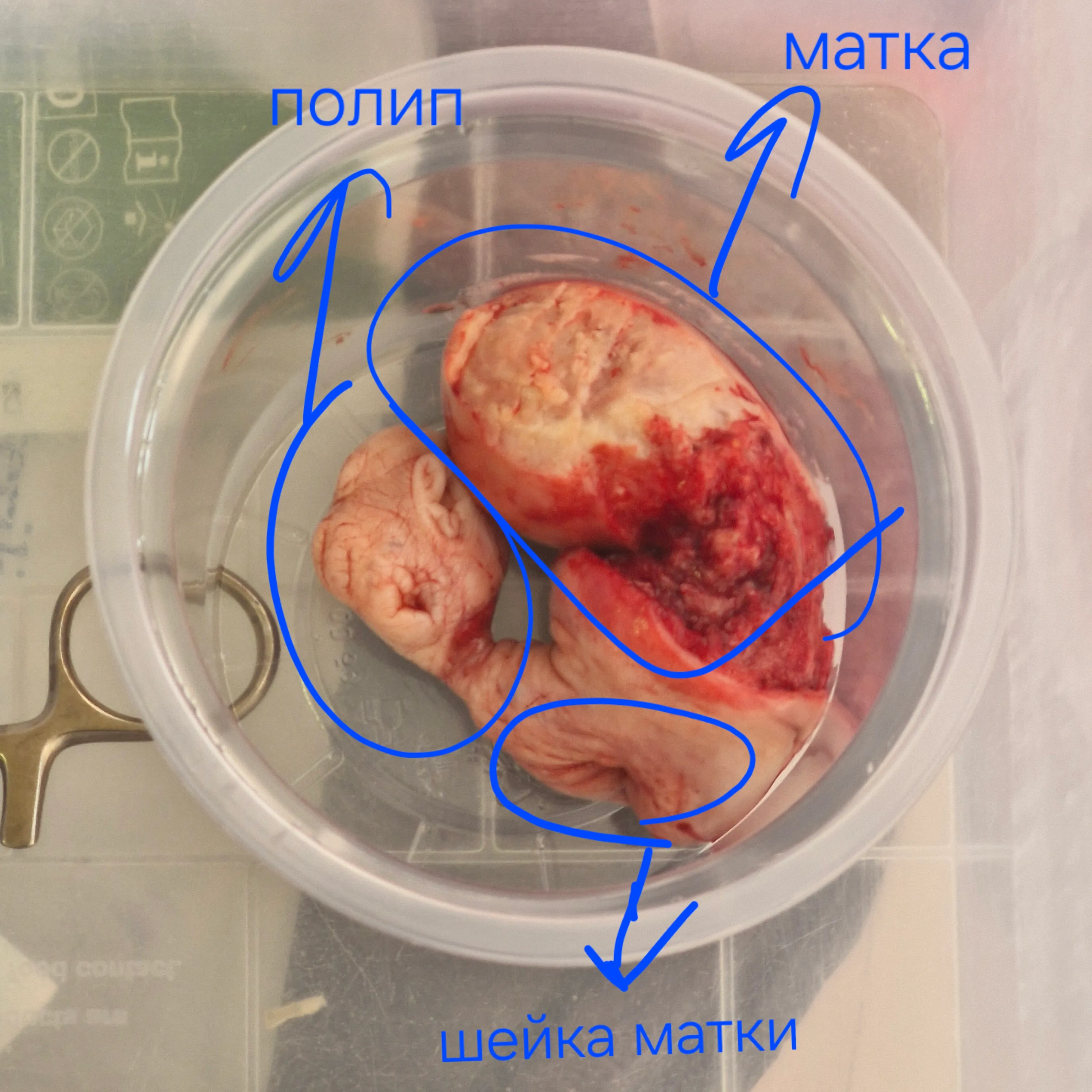 Полипэктомия #1