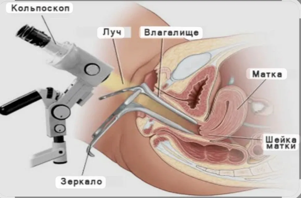 Что такое кольпоскопия? 🔬 #2