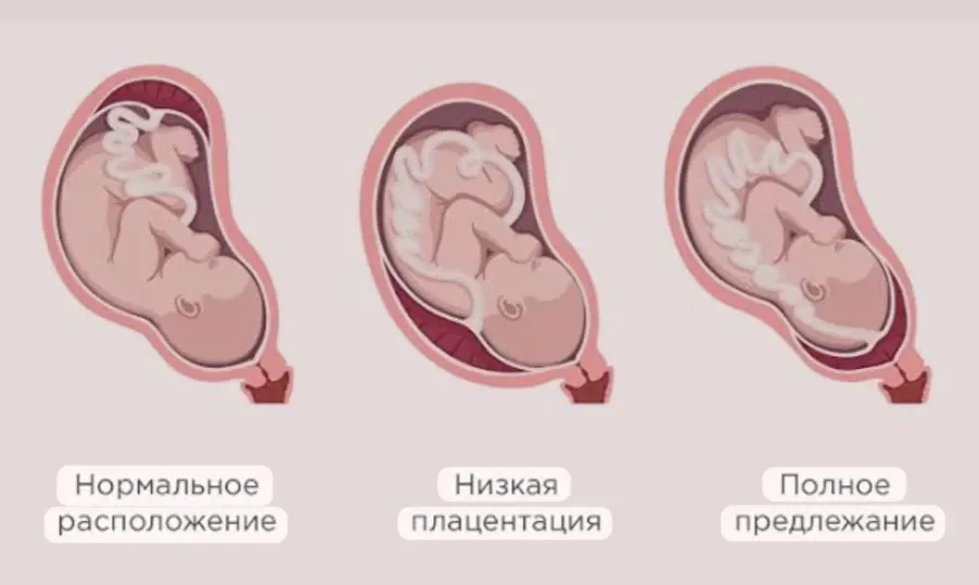 Предлежание плаценты  #2