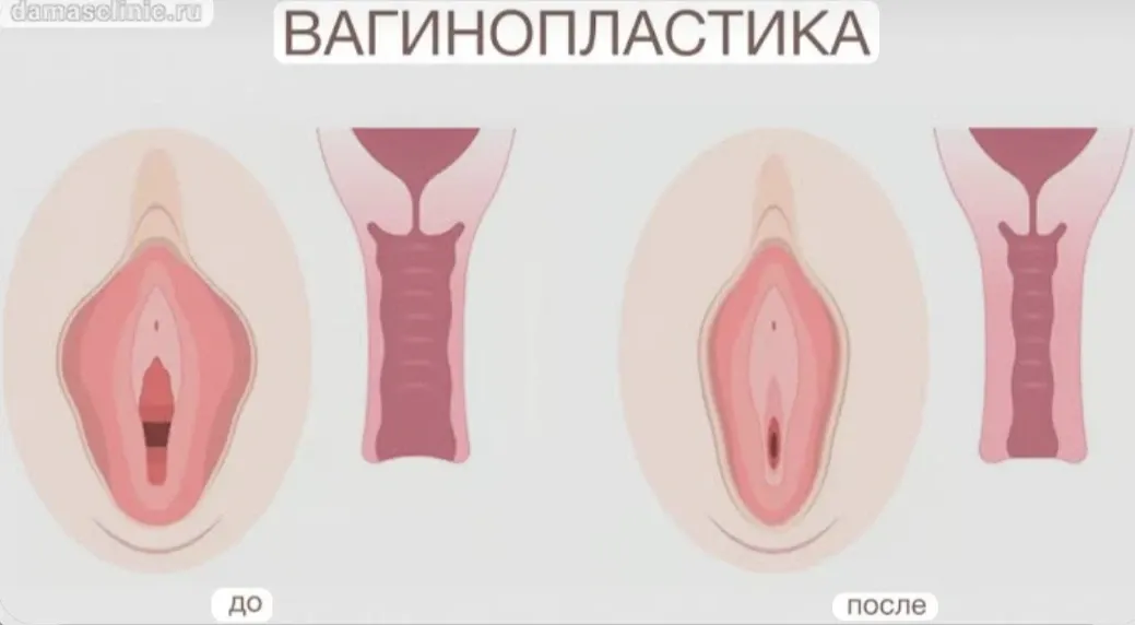 Пластика влагалища (вагинопластика)  #2