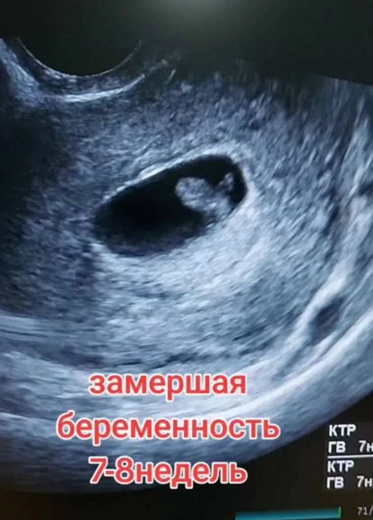Неразвивающаяся беременность💔: что это такое? #1