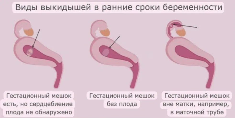 Неразвивающаяся беременность💔: что это такое? #3