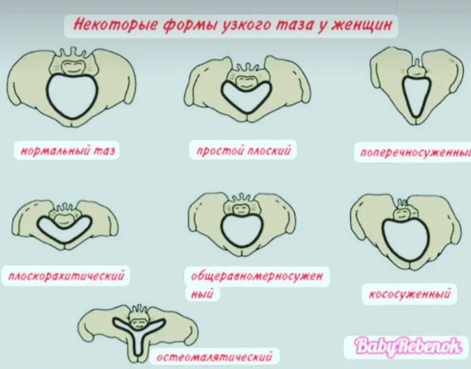 А вы знали, что таз может быть нормальных размеров, но роды всё равно не смогут протекать естественным путём? #2