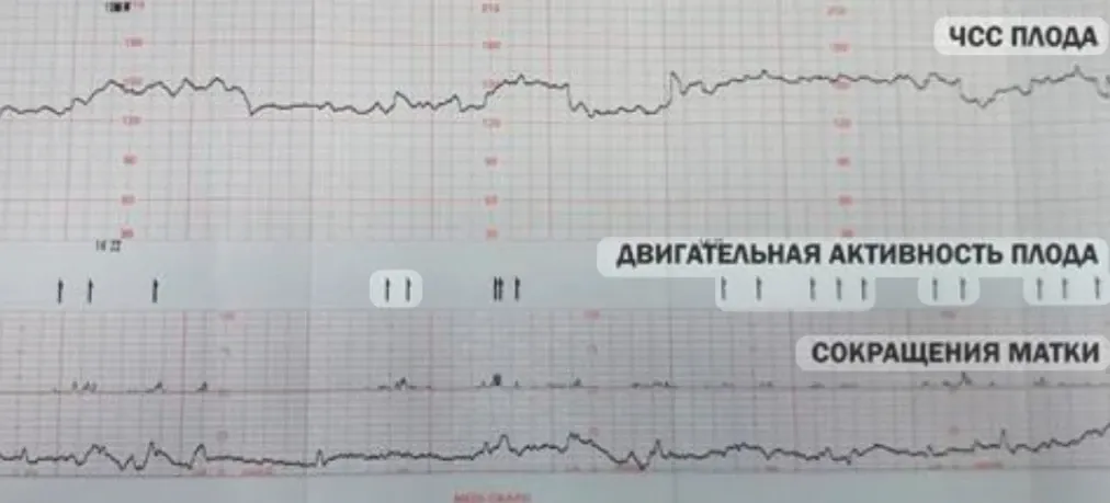 Что такое КТГ? 🤰🏻 #1