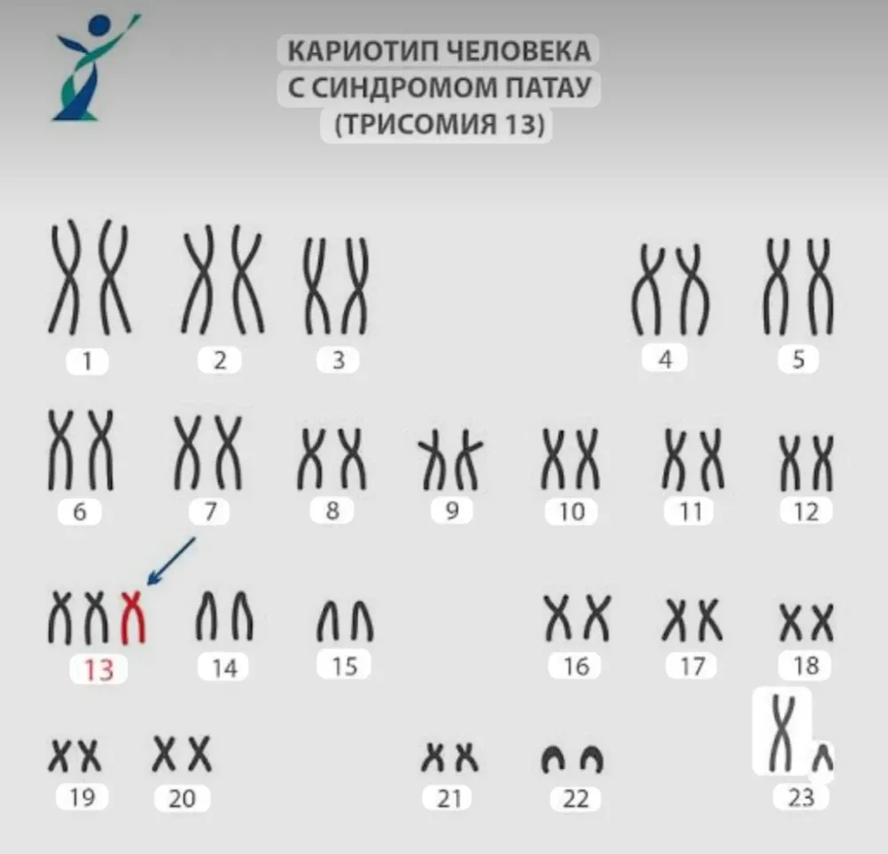 Синдром Патау  #2