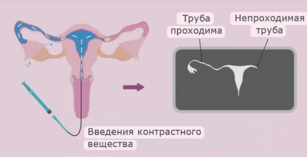 Сегодня мы наблюдали проведение гистеросальпингографии. #3