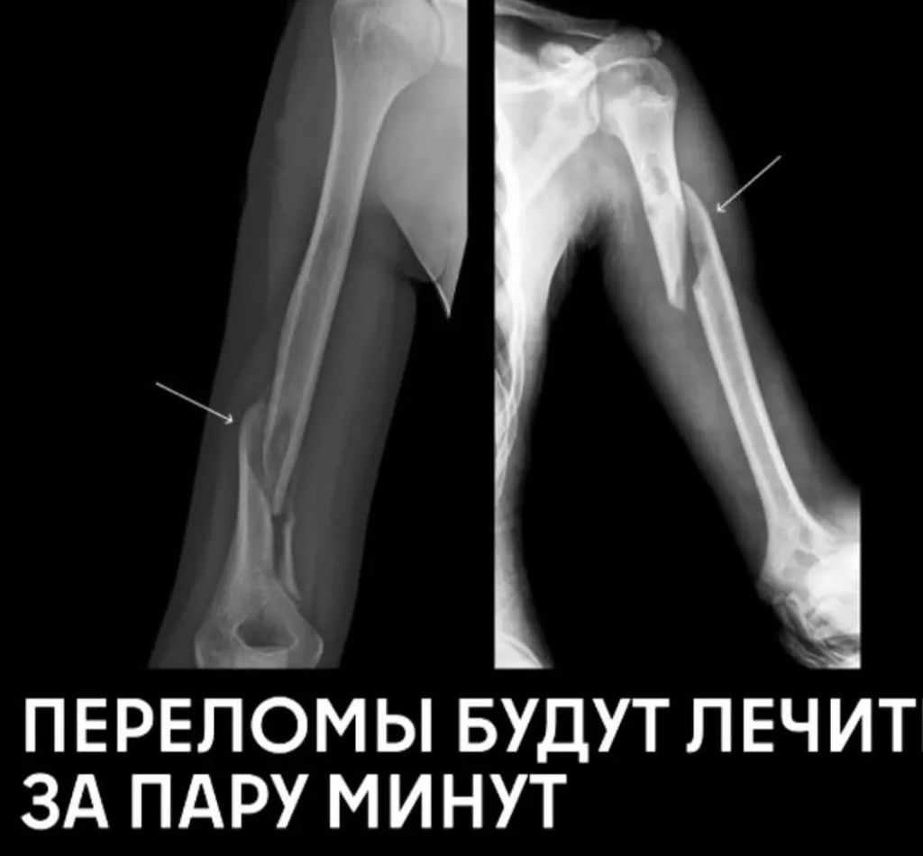 Инновационный Медицинский Клей "Bone-02" для Заживления Переломов за 2-3 Минуты #2